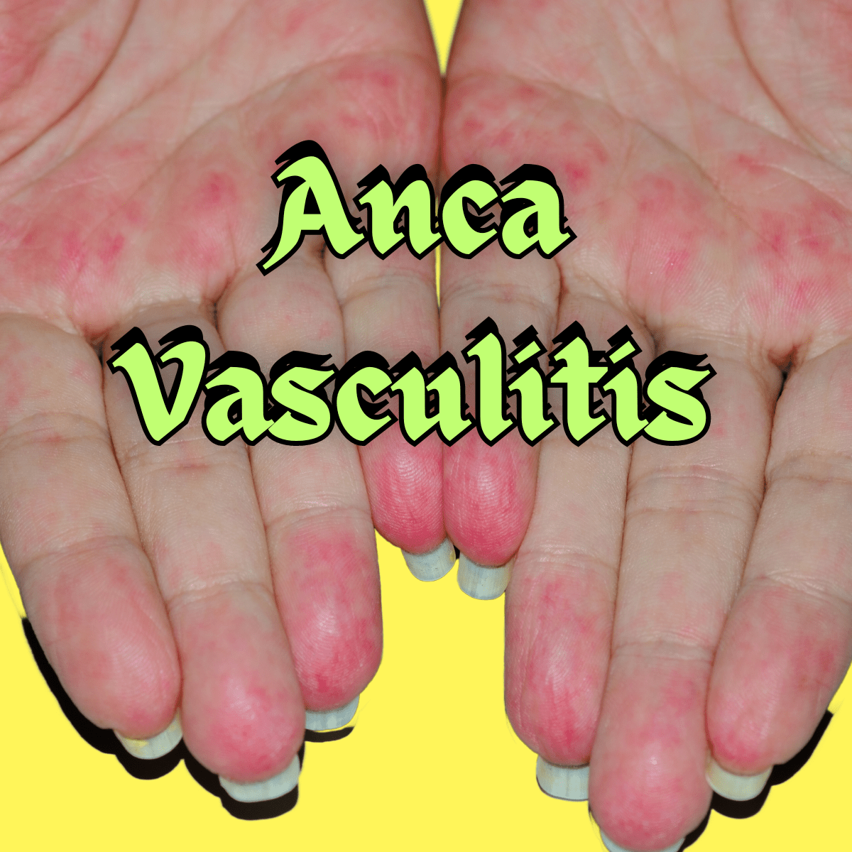 Anca Vasculitis